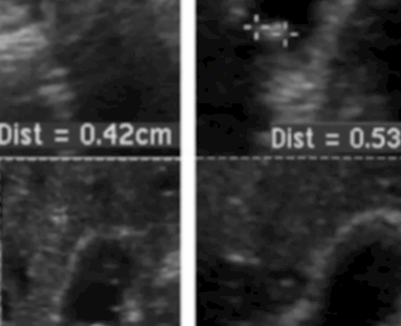 Longitudinal ultrasound of gallbladder polyps evaluated